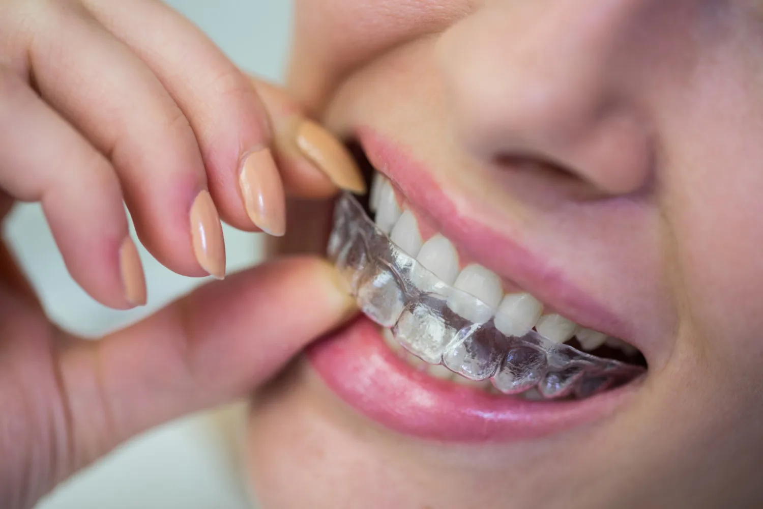 How to Find the Best Dentist for Implants Near Me in Falls Church