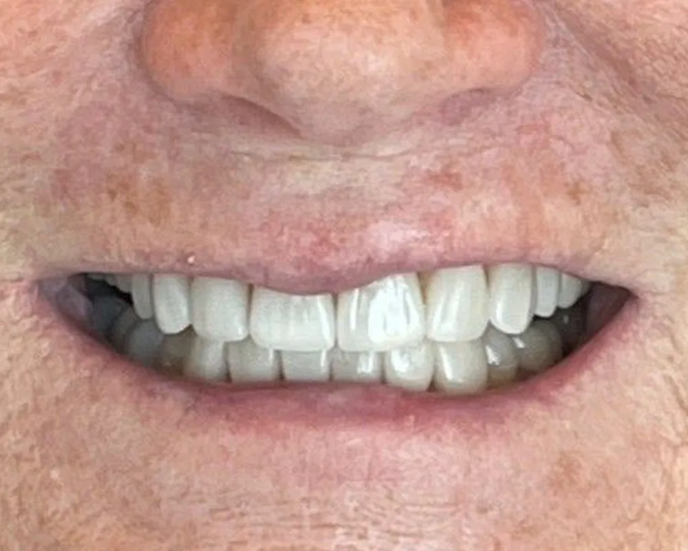 Patient smile after treatment at NOVA Dental Studio