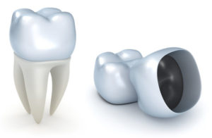 Crowns or "Caps" Repair Heavily Damaged Teeth