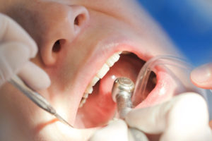 Dental Checkups Should Be Scheduled Every Sixth Months