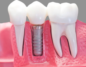 Dental Implants Are Extremely Versatile and Functional