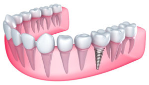 Detailed Model of a Dental Implant