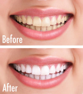 Teeth Whitening Is Easy With NOVA Dental Studio